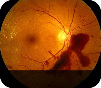 증식성당뇨망막병 증상안 Eye with Proliferative Diabetic Retinopathy