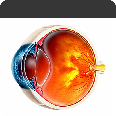 당뇨망막병증안 Diabetic Retinopathy Eye