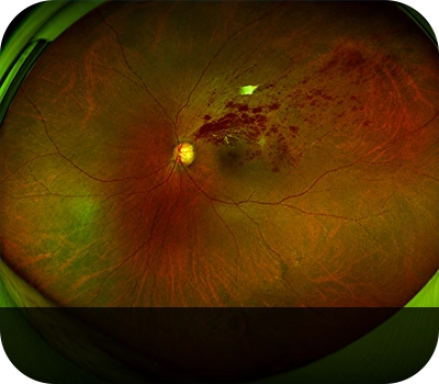 망막분지동맥폐쇄 증상안 Eye with Branch Retinal Artery Occlusion