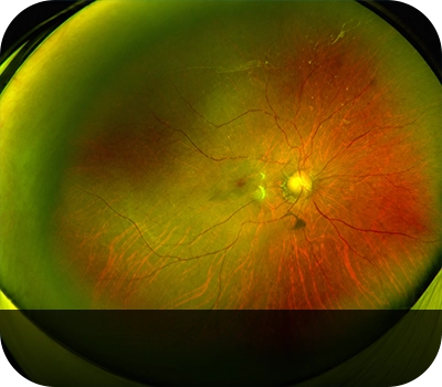 망막중심정맥폐쇄 증상안 Eye with Central Retinal Vein Occlusion