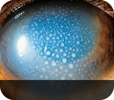 포도막염 증상안 Eye with Uveitis