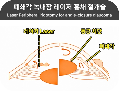 폐쇄각 녹내장 레이저 홍채 절개술 단면도