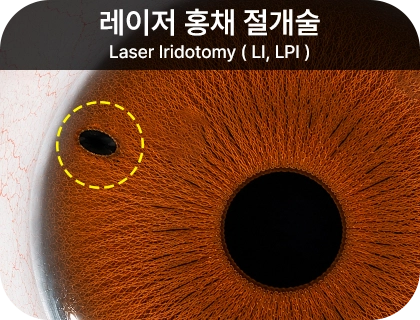 레이저 홍채 절개술 시술 개념도