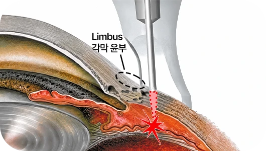 모양체 광응고술 일러스트