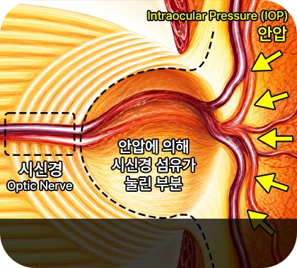 녹내장 환자의 시신경