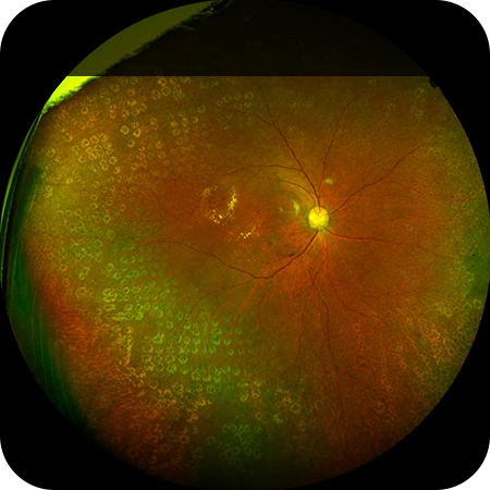 범망막 광응고술 PRP Panretinal Photocoagulation