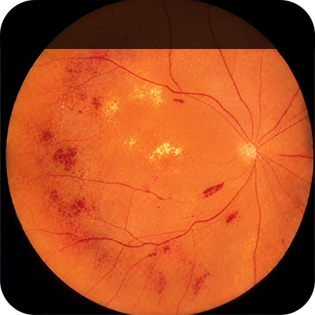 당뇨망막 출혈 Eye with Diabetic Retinal Hemorrhage
