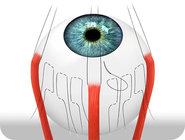 Scleral Imbrication — 공막을 봉합해 길어진 안축장을 단축하는 수술 일러스트