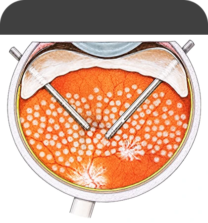 유리체 절제술 레이저 Endolaser Photocoagulation