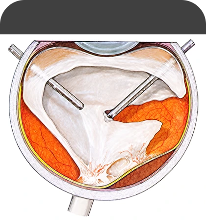 유리체 절제술 Vitrectomy