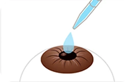STEP 1 - Topical anesthesia