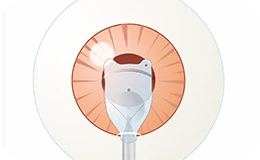 STEP 3 - ICL insertion