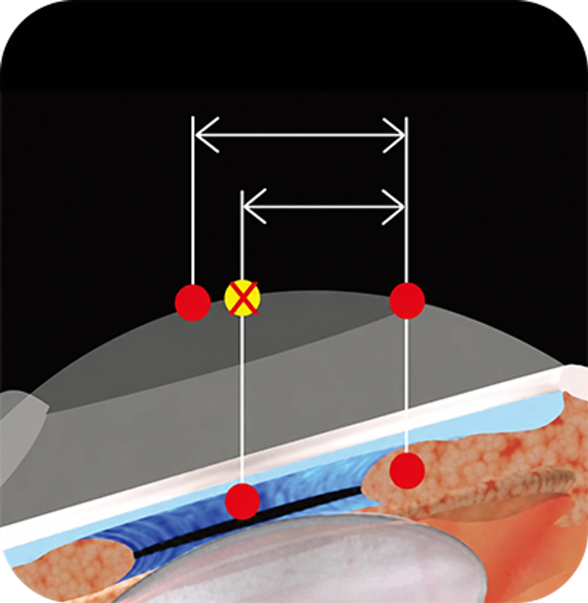 각막 두께 측정 시스템 — Corneal Thickness Measurement System