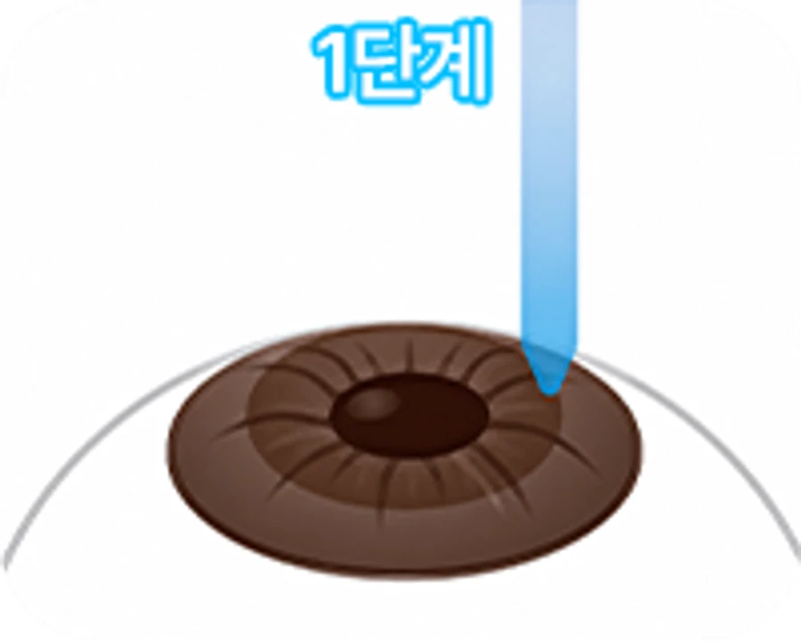STEP 2 - 각막상피 제거