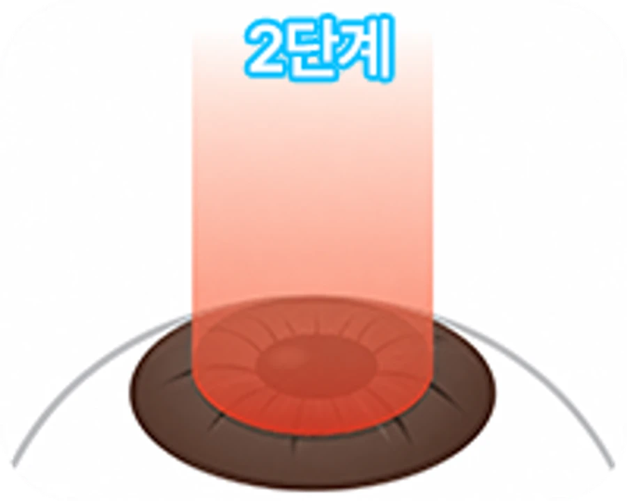 STEP 3 - 각막실질부 교정