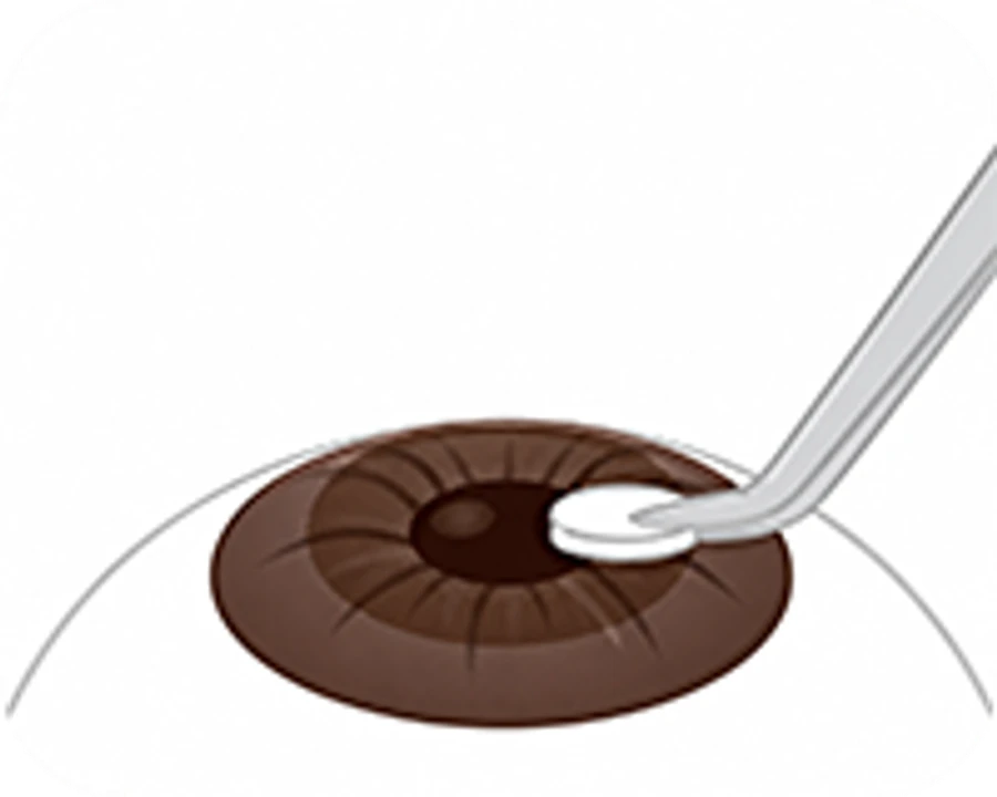 STEP 4 - 마이토마이신 처치