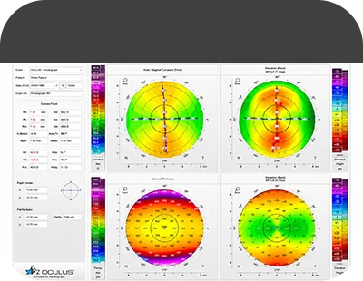 Keratograph 5M 화면 — 각막 곡률 측정 결과