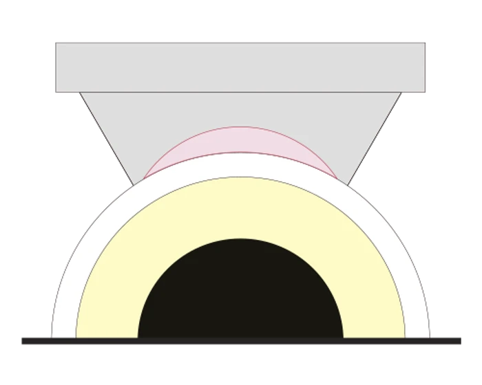 Conventional SMILE docking — unstable contact may cause eye compression and suction loss