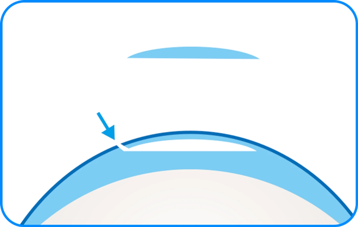 Cornea cross-section — Clear SMILE LASIK