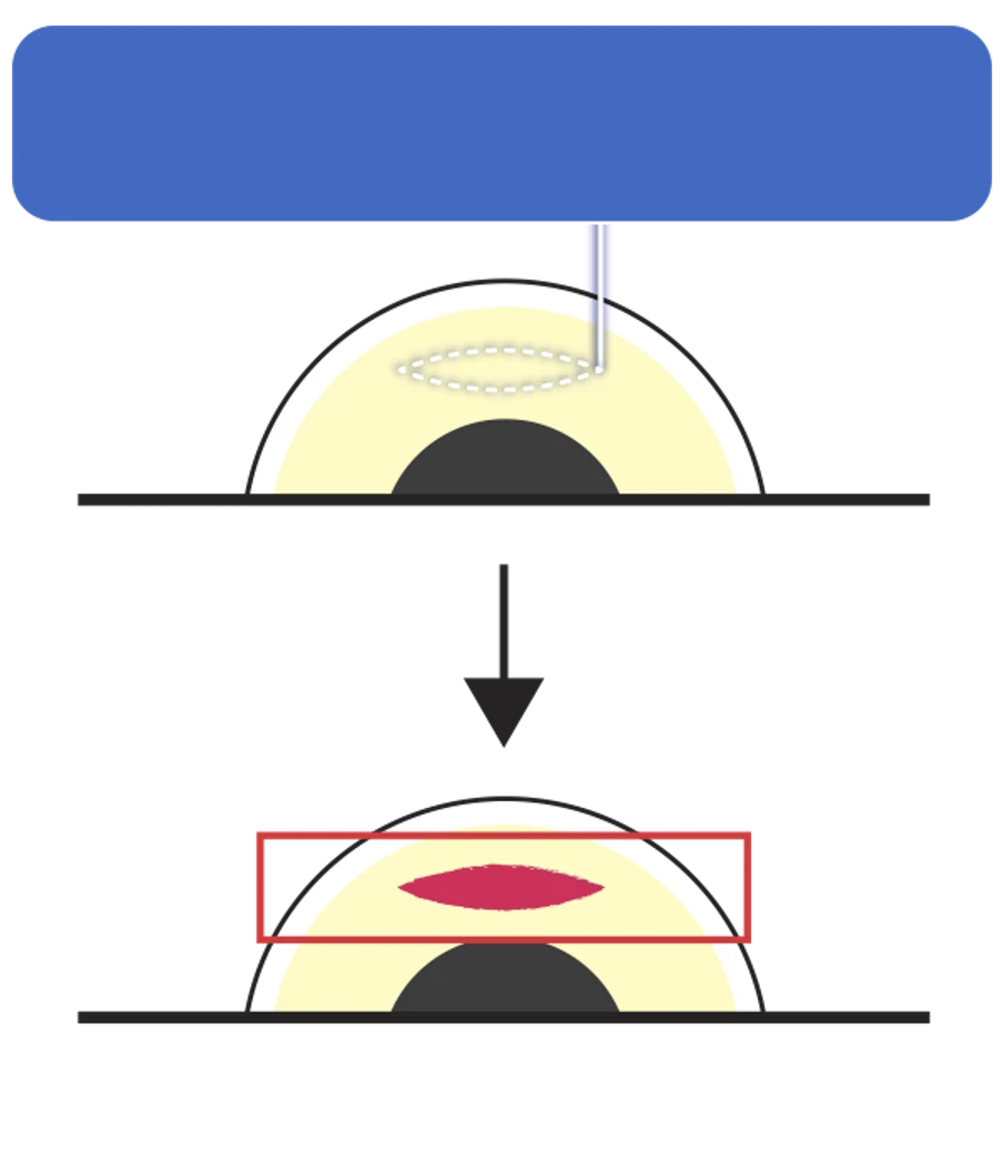 Conventional SMILE — lower-speed laser may leave undivided regions in the corneal stroma