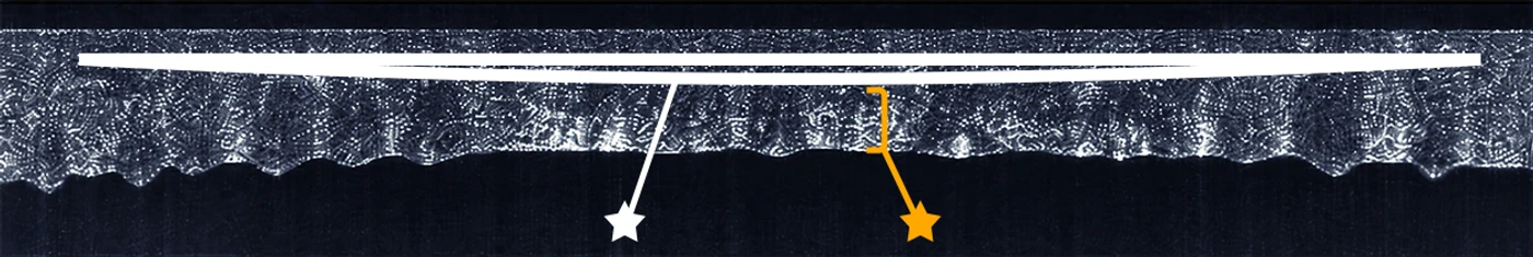 High-resolution OCT full scan — lenticule position indicators