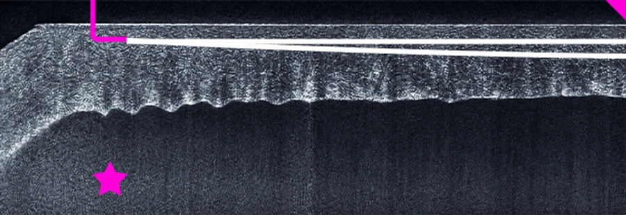 Anterior side incision and guide tunnel OCT scan