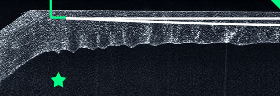Posterior side incision and guide tunnel OCT scan