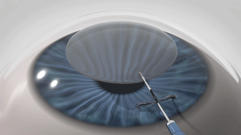 STEP 3 — lenticule extraction